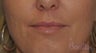 49 y/o female desired fuller lips with filler.
