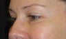 Restylane