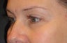 Restylane