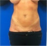 Laser Liposuction