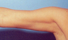 Arm Liposuction