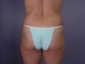 Bodylift