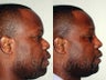 32 year old African American Male - Rhinoplasty