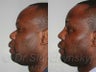 32 year old African American Male - Rhinoplasty