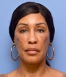 Facial Dermafillers