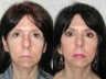 SLUPlift (Mini-lift procedure), Revision Blepharoplasty and Lateral Canthopexy