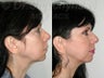 SLUPlift (Mini-lift procedure), Revision Blepharoplasty and Lateral Canthopexy
