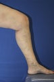 vnus ablation