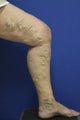 vnus ablation