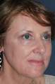 Laser Resurfacing for Wrinkle Reduction