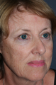 Laser Resurfacing for Wrinkle Reduction