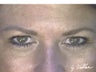 Transconjunctival Blepharoplasty