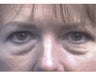 Transconjunctival Blepharoplasty