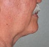 65 Year Old Male Treated For Sagging Neck