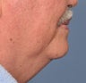 65 Year Old Male Treated For Sagging Neck