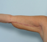 Arm Lift