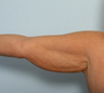 Arm Lift