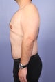 37 yr old weight loss patient