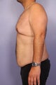 37 yr old weight loss patient