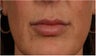 44 Year old female with thin lips wants fuller natural lips without surgery