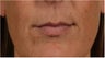 44 Year old female with thin lips wants fuller natural lips without surgery