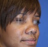 Young woman with bulbous nose treated with rhinoplasty