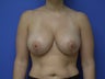 34 yo female with breast lift and breast implants / augmentation
