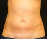 CoolSculpting