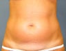 CoolSculpting