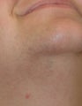 Laser Hair Removal Before and After Photos