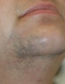 Laser Hair Removal Before and After Photos