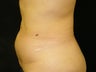 CoolSculpting