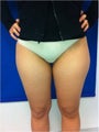 Laser Liposuction