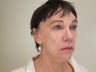 70 Year old Female - "Softlift" treatment (combination Juvederm & Botox)