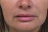 Juvederm Treatment