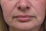 Juvederm Treatment
