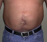26 Year Old Male With Large Abdominal Scar