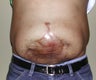 26 Year Old Male With Large Abdominal Scar