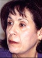 Revision rhinoplasty