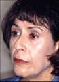 Revision rhinoplasty