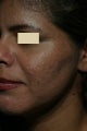 Acne scars
