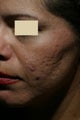 Acne scars