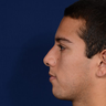 Rhinoplasty