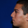 Rhinoplasty