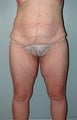 Female patient who received surgery after major weight loss