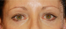 Eye Bag Surgery