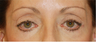 Eye Bag Surgery