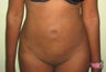 lipodistrofy back and belly