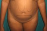 lipodistrofy back and belly