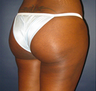 Butt Augmentation